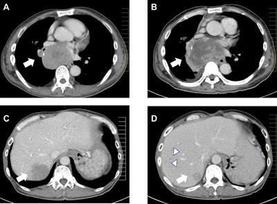 Multiple endocrine neoplasia type 1 with Zollinger–Ellison syndrome: clinicopathological analysis of a Japanese family with focus on menin immunohistochemistry